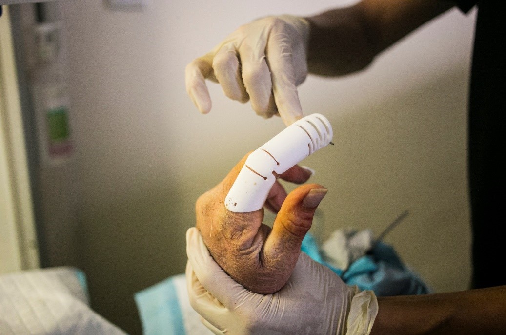 Dynamic Traction Splint for PIPJ-DFD