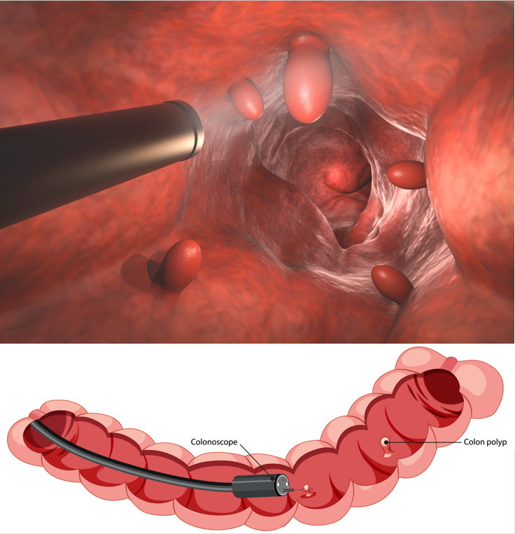 5. Colonoscopy 5. Colonoscopy